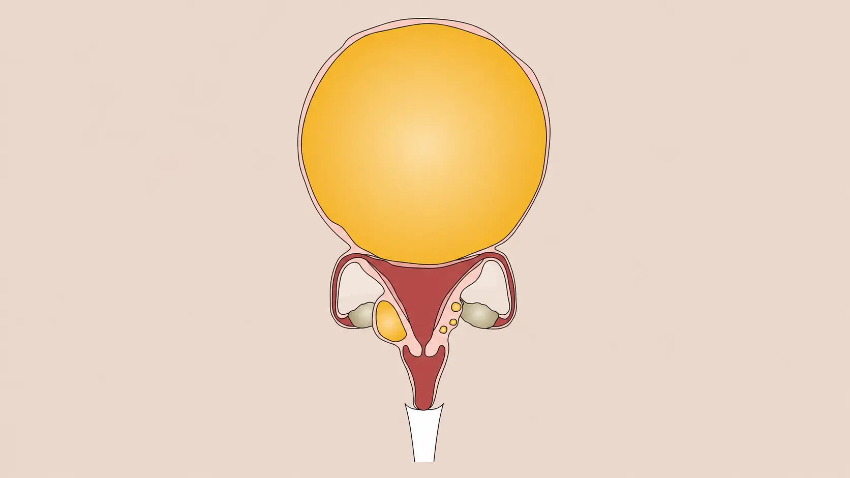 fibroids